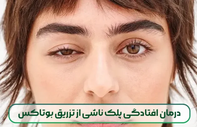 درمان افتادگی پلک ناشی از تزریق بوتاکس