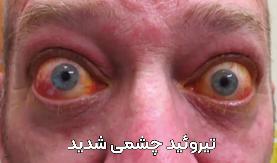  تیروئید چشمی شدید