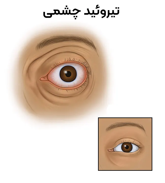 بیماری تیروئید چشمی