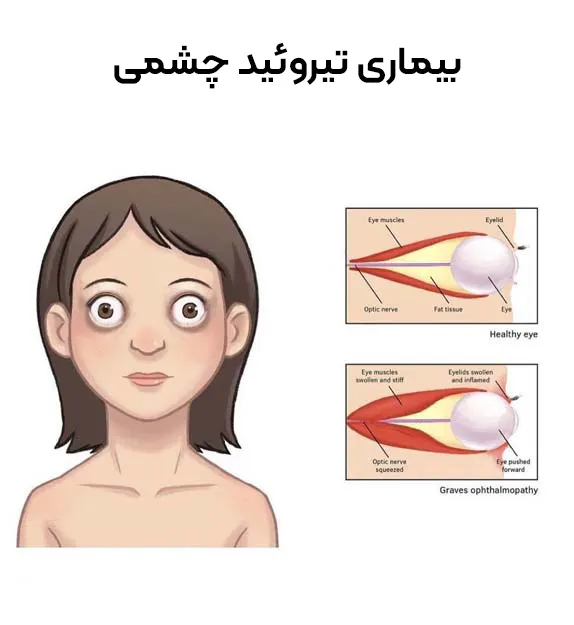 بیماری تیروئید چشمی