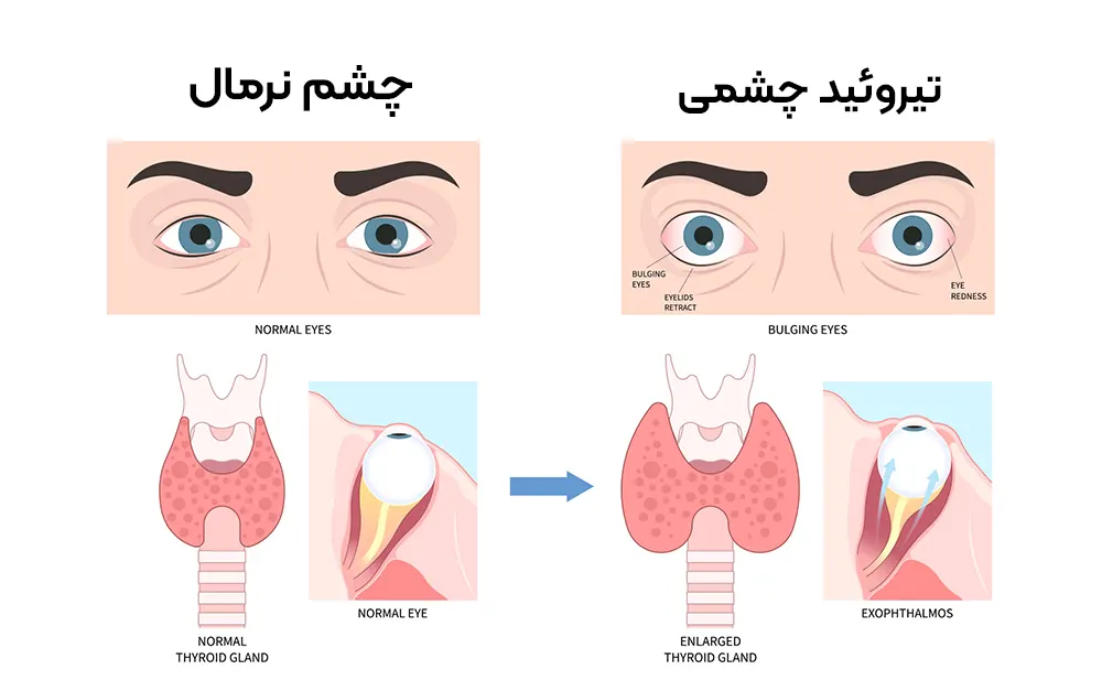 علت بیماری تیروئید چشمی