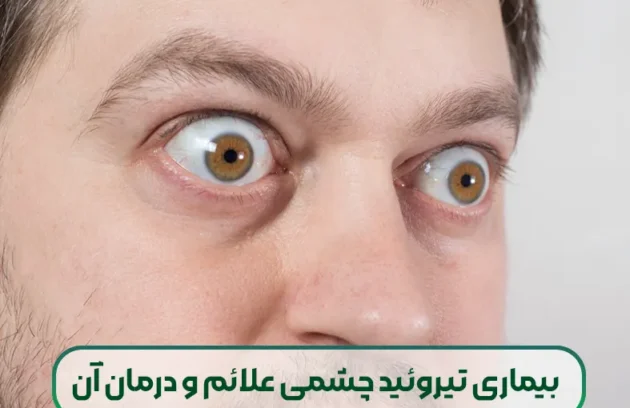 بیماری تیروئید چشمی علائم و درمان آن