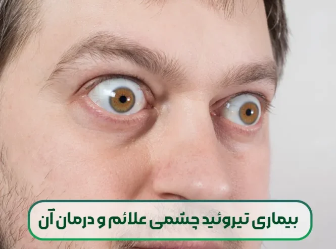 بیماری تیروئید چشمی علائم و درمان آن