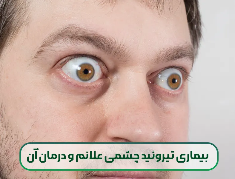 بیماری تیروئید چشمی علائم و درمان آن