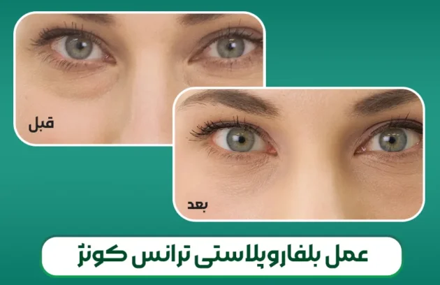 عمل بلفاروپلاستی ترانس کونژ