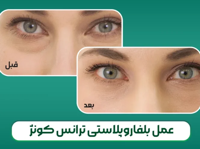 عمل بلفاروپلاستی ترانس کونژ
