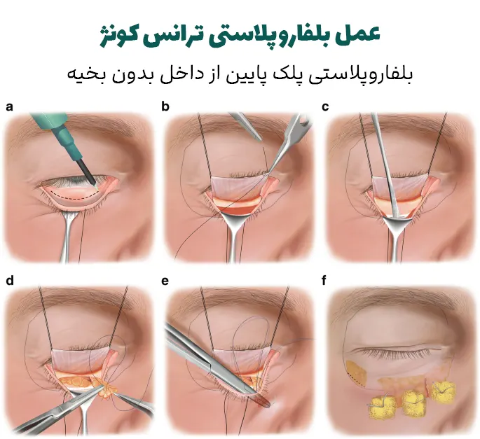 بلفاروپلاستی تحتانی بدون بخیه