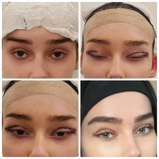 جراحی چشم روباهی