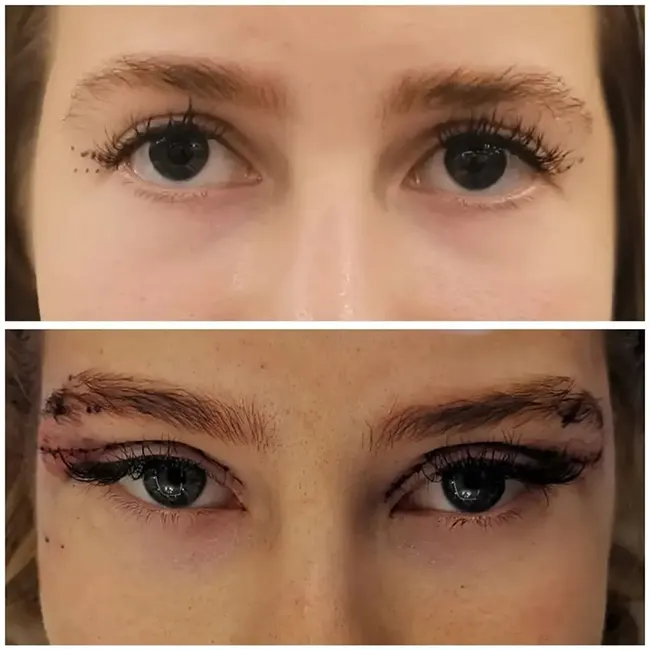 جراحی چشم روباهی