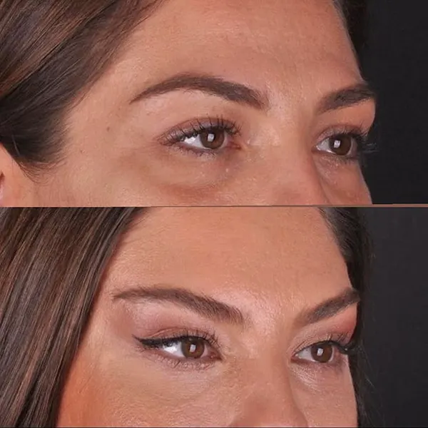 جراحی چشم روباهی