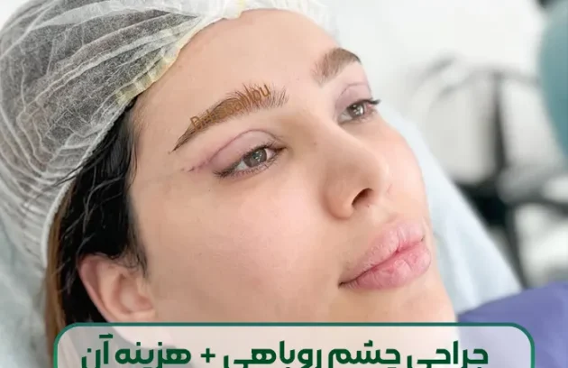 جراحی چشم روباهی