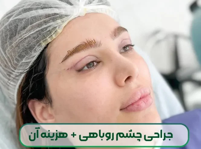 جراحی چشم روباهی