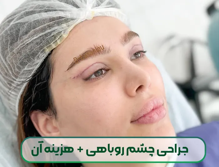 جراحی چشم روباهی