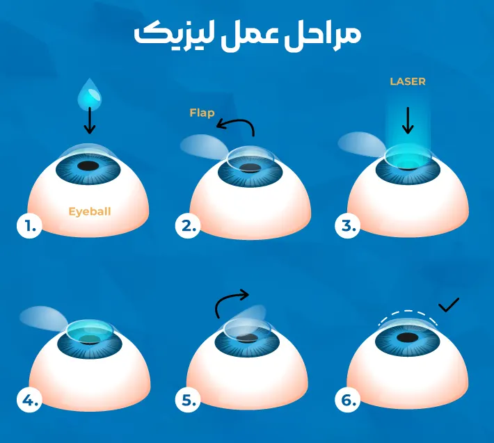 عمل لیزیک