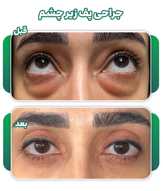 درمان پف زیر چشم
