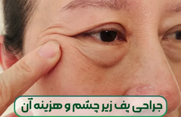 جراحی از بین بردن پف و ورم زیر چشم