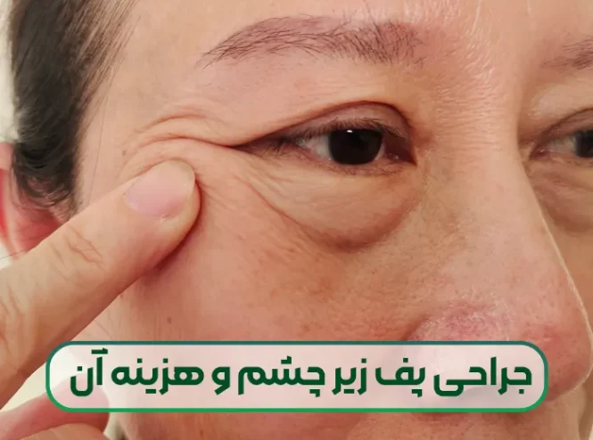 جراحی از بین بردن پف و ورم زیر چشم
