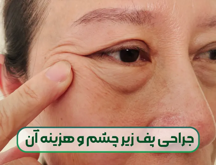 جراحی از بین بردن پف و ورم زیر چشم