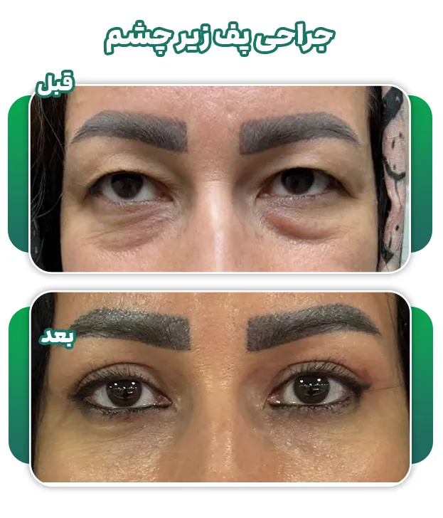 جراحی پف زیر چشم