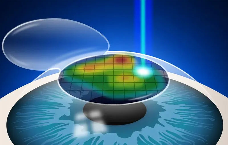 لیزیک برای آستیگماتیسم