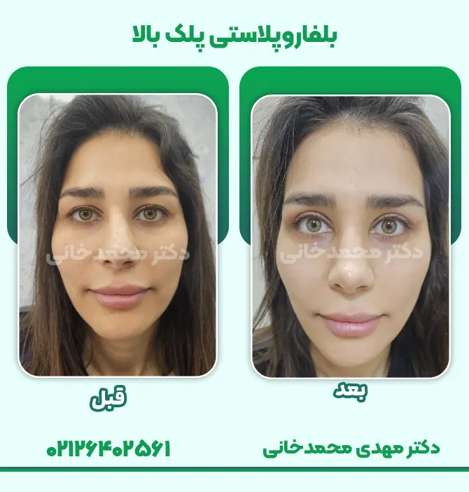 بلفاروپلاستی پلک بالا