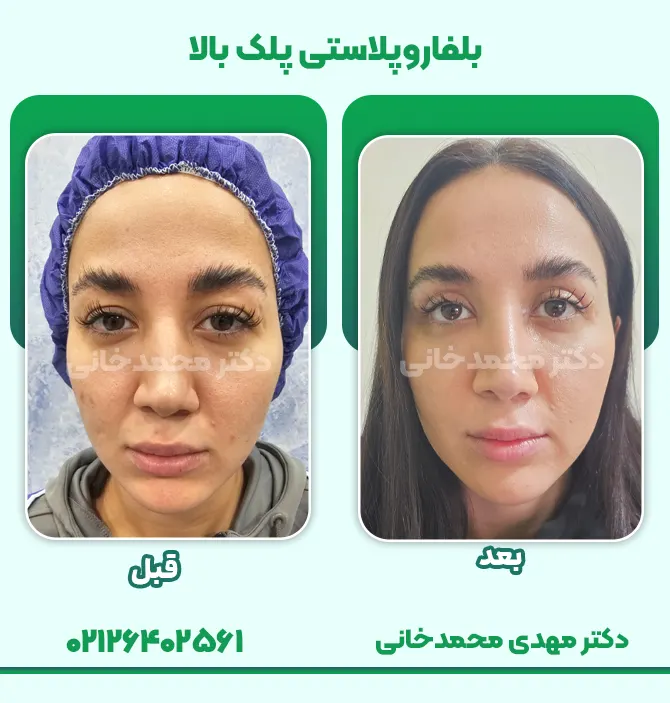 بلفاروپلاستی پلک بالا