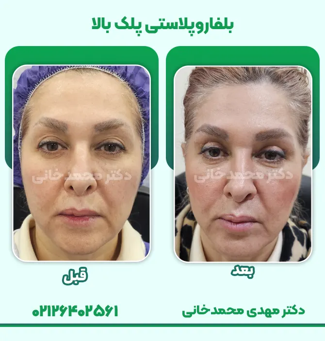 بلفاروپلاستی پلک بالا