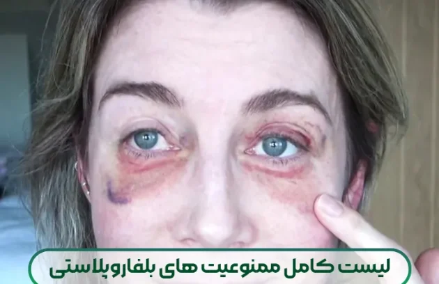 لیست کامل ممنوعیت های بلفاروپلاستی