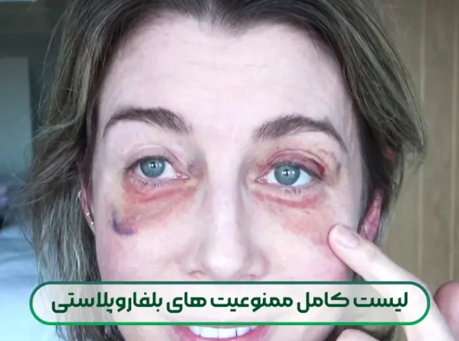 لیست کامل ممنوعیت های بلفاروپلاستی
