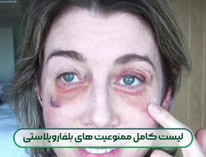 لیست کامل ممنوعیت های بلفاروپلاستی