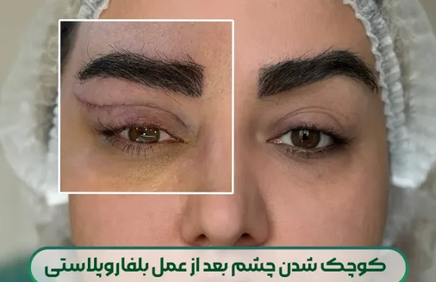 کوچک شدن چشم بعد از عمل بلفاروپلاستی