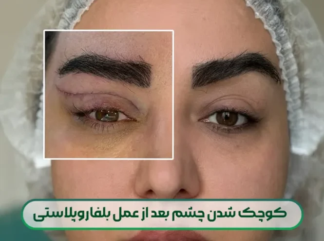 کوچک شدن چشم بعد از عمل بلفاروپلاستی