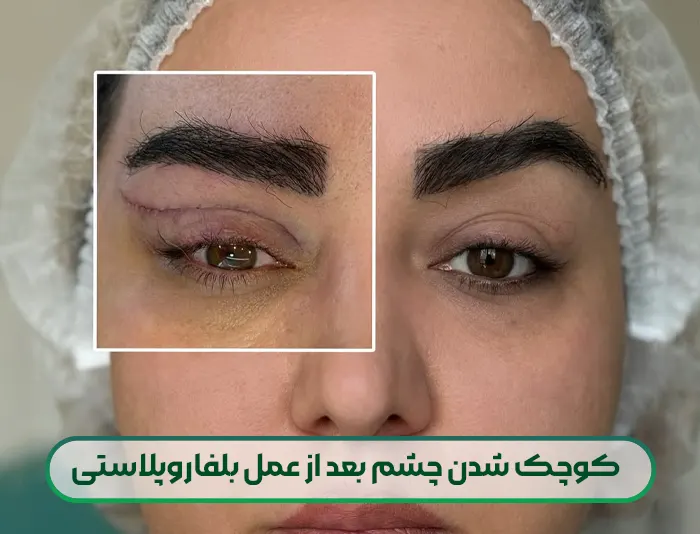 کوچک شدن چشم بعد از عمل بلفاروپلاستی