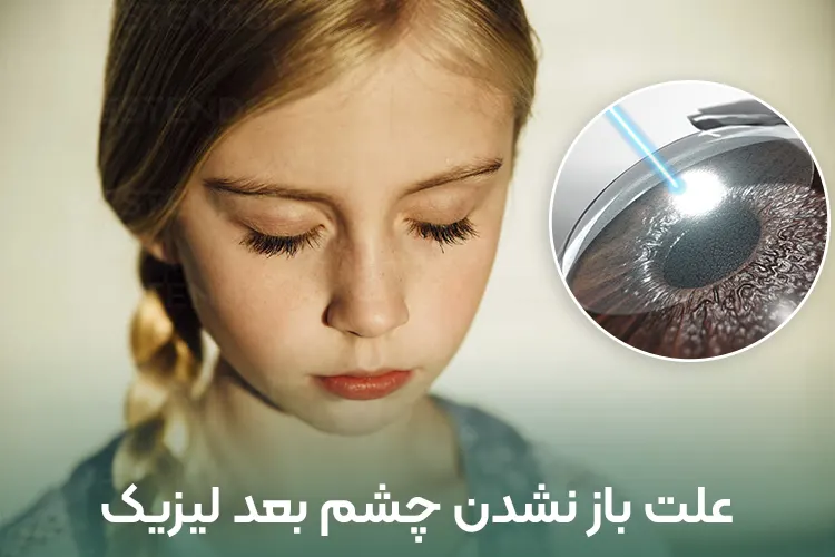 باز نشدن چشم بعد از عمل لیزیک