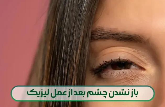 باز نشدن چشم بعد از عمل لیزیک