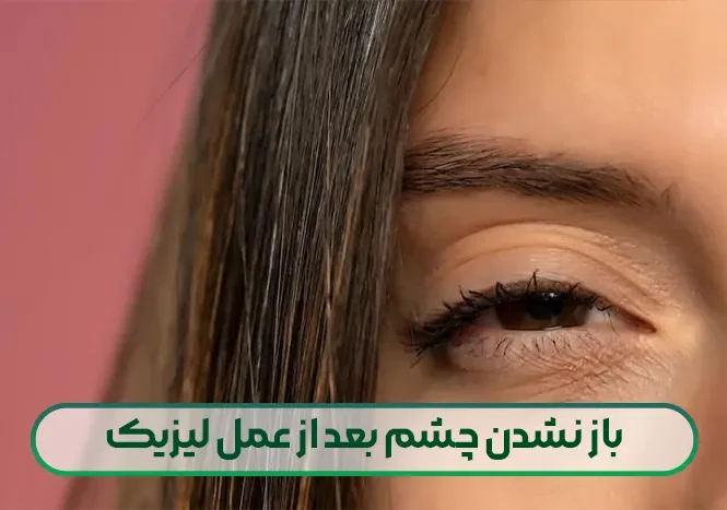 باز نشدن چشم بعد از عمل لیزیک