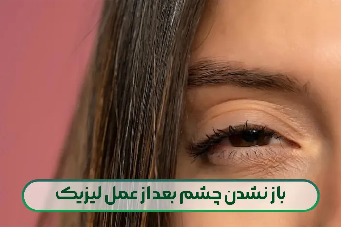 باز نشدن چشم بعد از عمل لیزیک