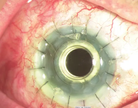 پیوند قرنیه مصنوعی