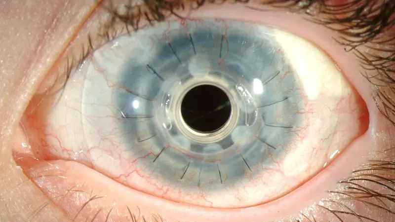 پیوند قرنیه مصنوعی