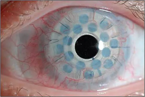 پیوند قرنیه مصنوعی