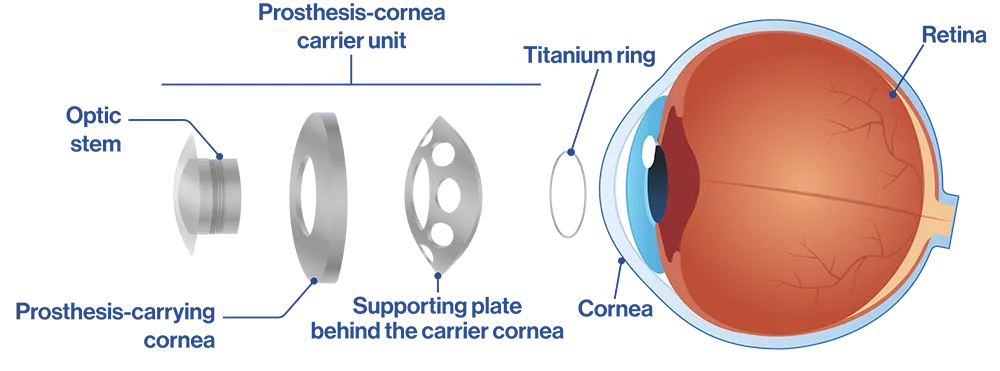 پیوند قرنیه مصنوعی