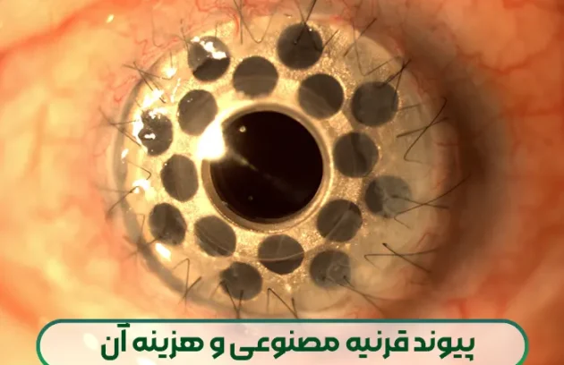 پیوند قرنیه مصنوعی