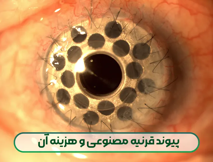 پیوند قرنیه مصنوعی