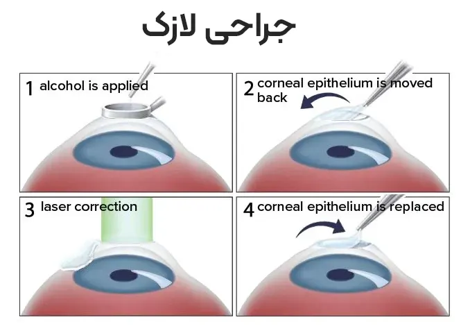 جراحی لازک