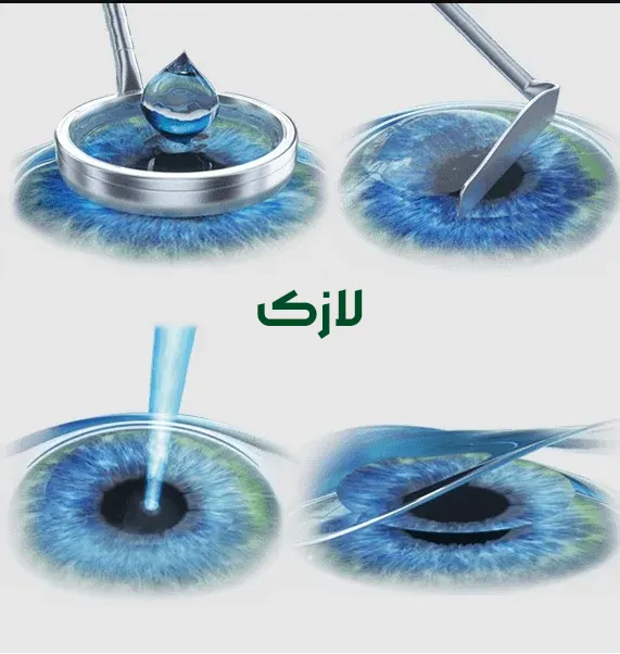 لازک