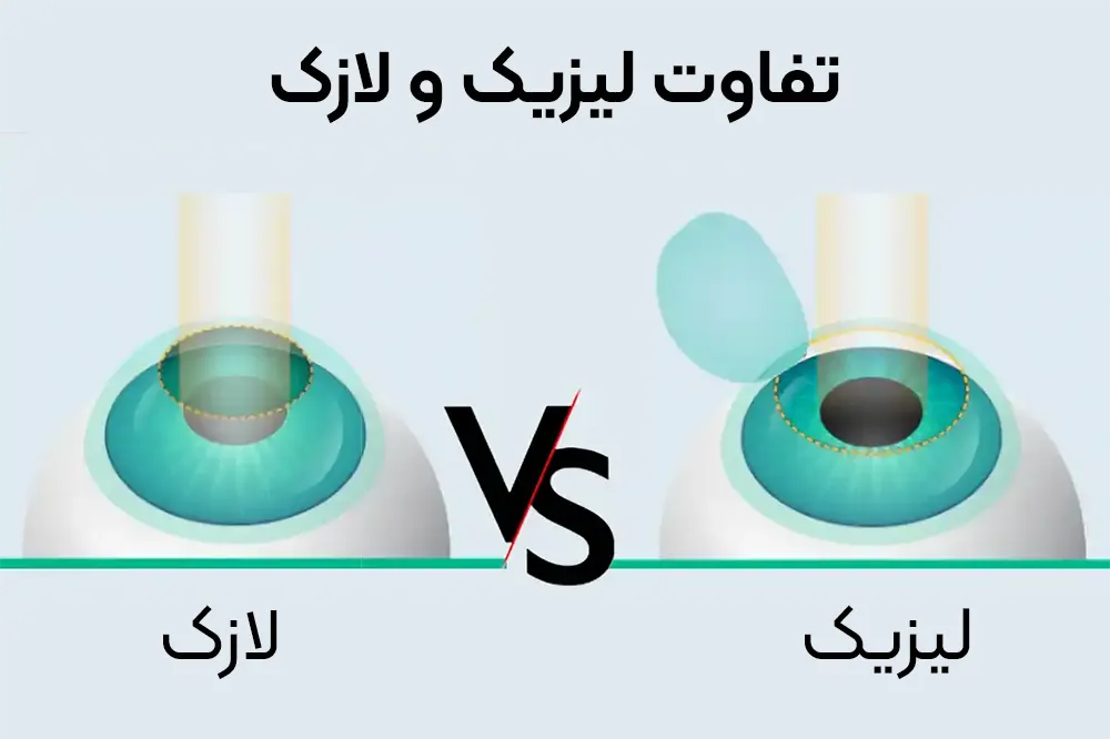 مقایسه کلی جراحی لازک و لیزیک