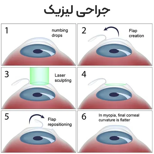 جراحی لیزیک