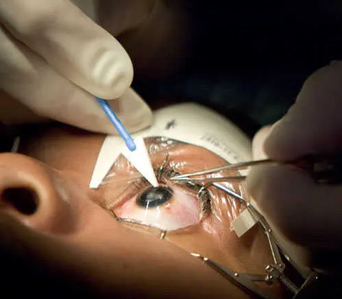 عمل لیزیک چشم