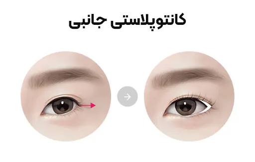 کانتوپلاستی جانبی