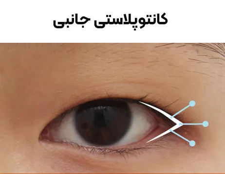 کانتوپلاستی جانبی